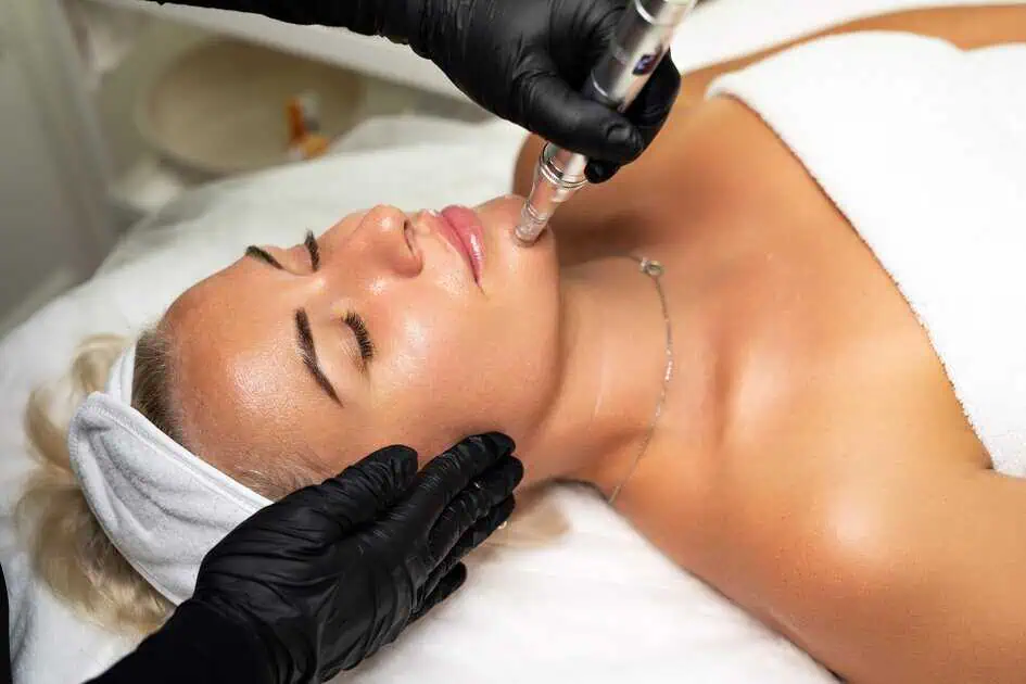 Vivace RF Microneedling in Sandy Springs GA by Modern looks med spa