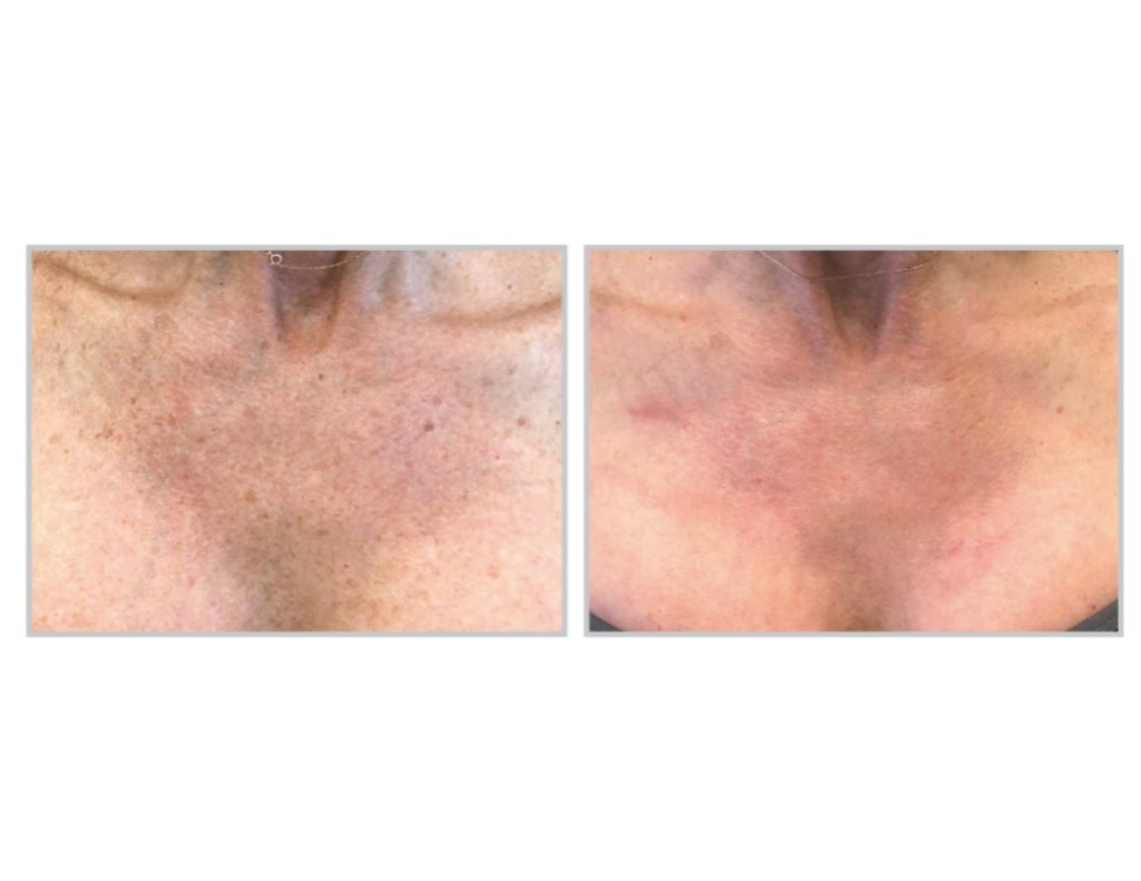 BBL Hero Laser Treatment in Sandy Springs GA