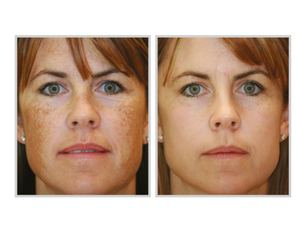 BBL Hero Laser Treatment in Sandy Springs GA